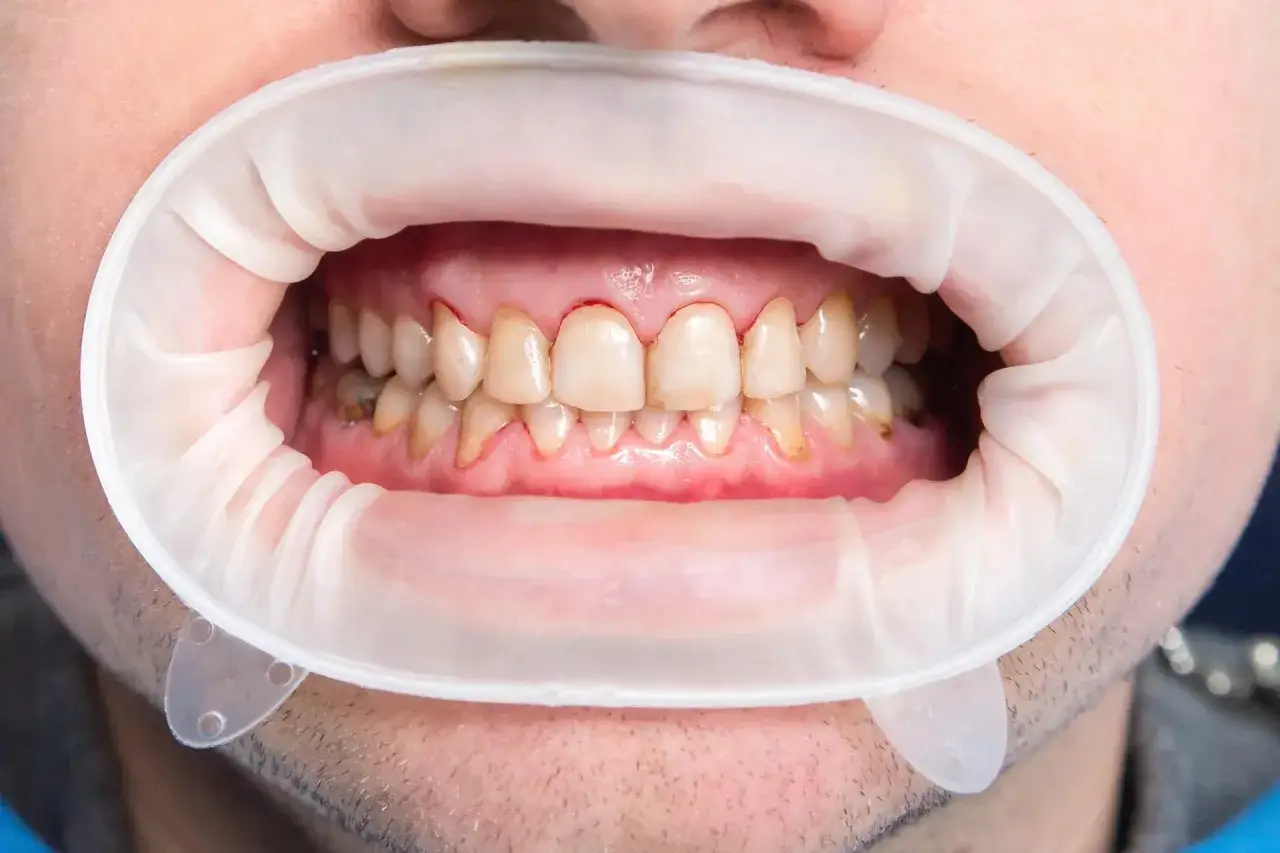 Widoczne białe plamy na zębach, które mogą świadczyć o problemach z szkliwem. Widoczny retraktor dentystyczny.