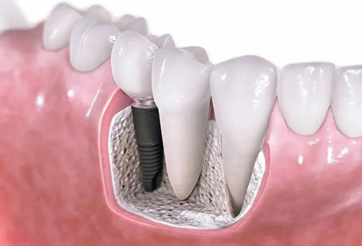 Implant zębowy w kości, ilustracja pokazująca sterowana regeneracja kości wokół implantu.