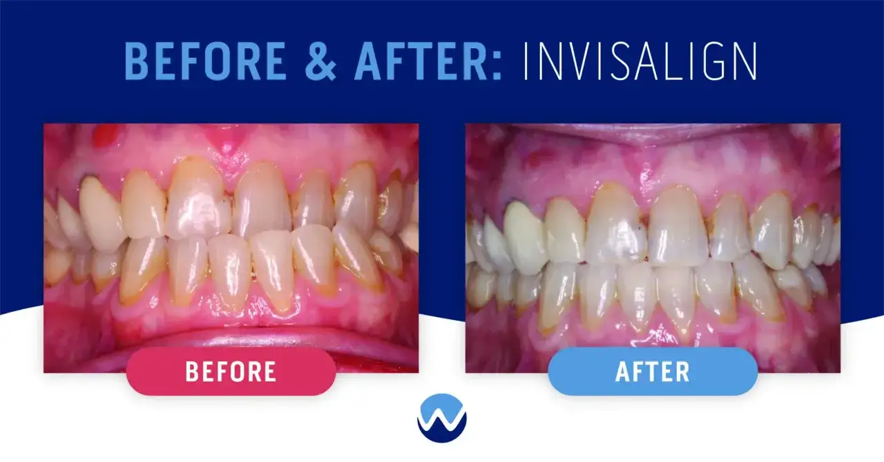 Przed i po: krzywe zęby przed i po zastosowaniu nakładek na zęby Invisalign.