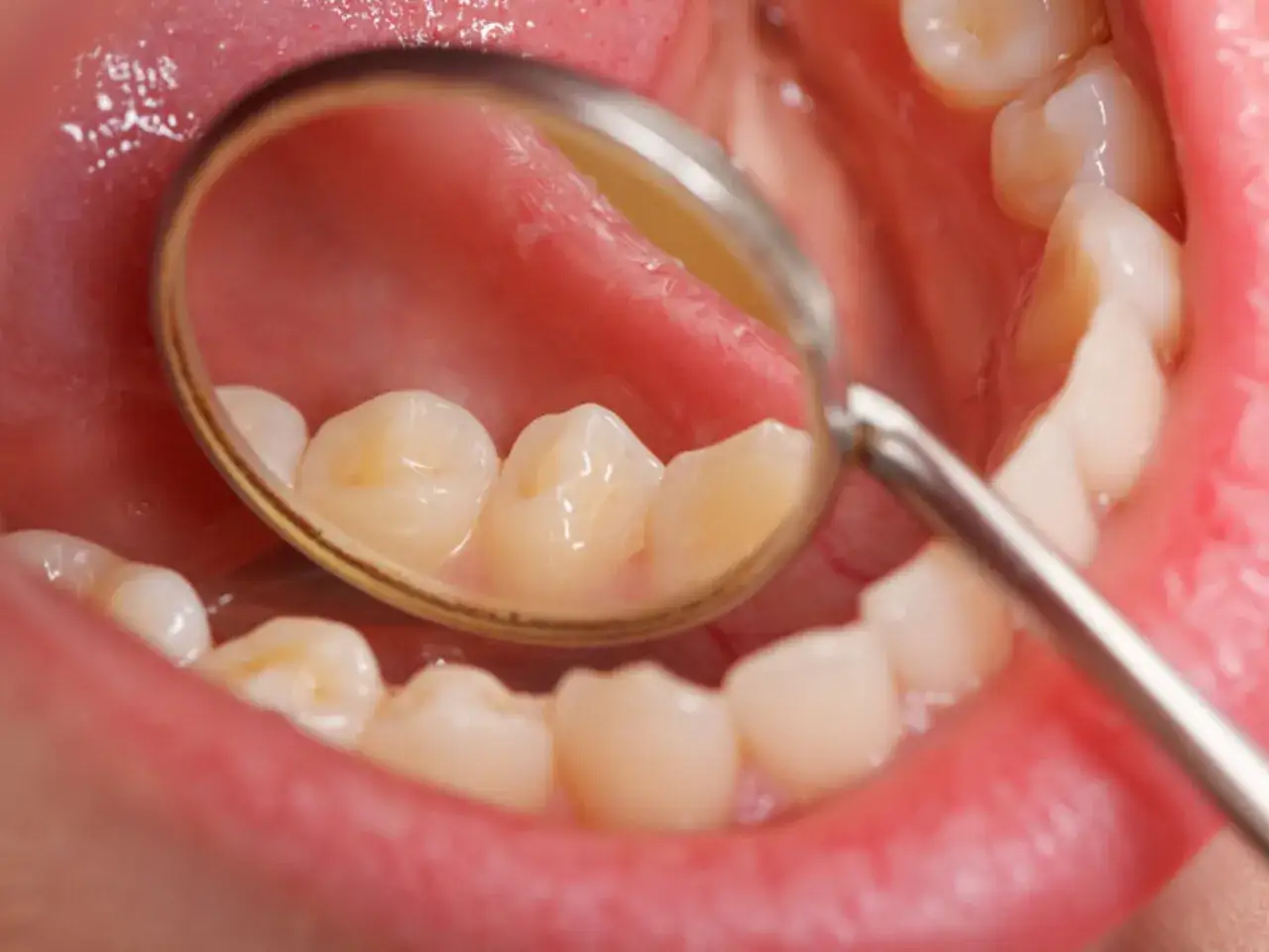 Widok jamy ustnej z lusterkiem dentystycznym, uwidaczniającym zęby z przebarwieniami, mogącymi świadczyć o fluoroza lub odwapnienie.