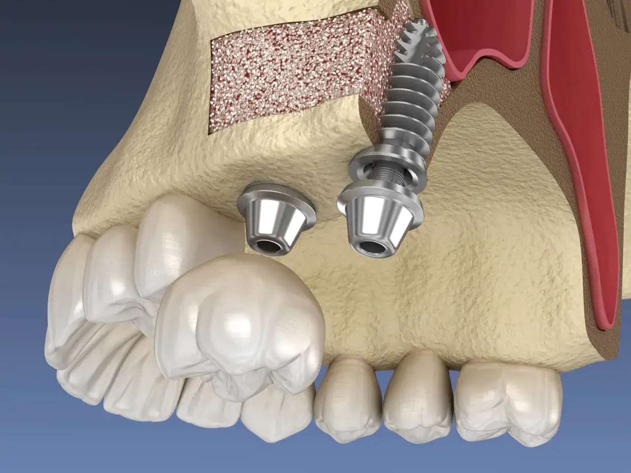 Model szczęki z implantami i materiałem kostnym, ilustrujący podniesienie dna zatoki szczękowej.