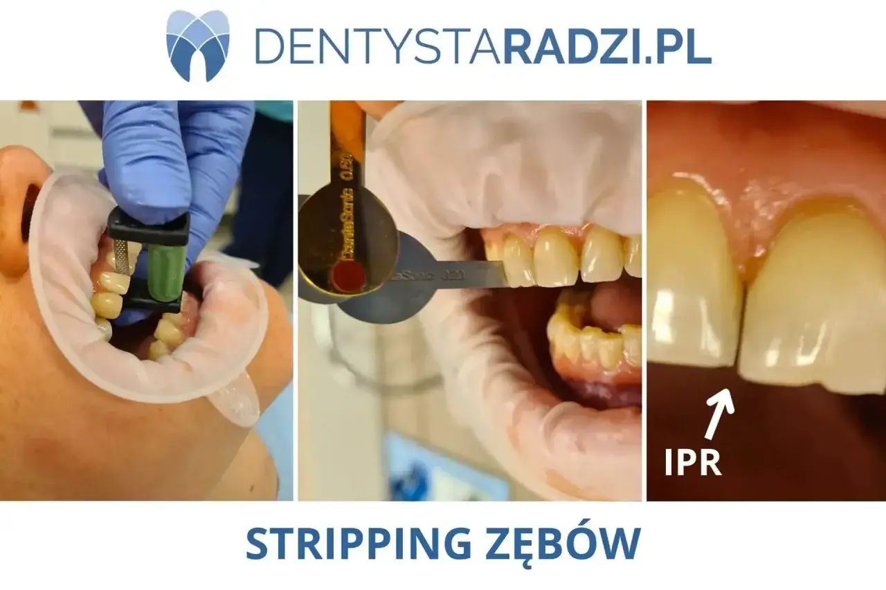Zabieg piłowania zębów (IPR) w celu korekty zgryzu. Dentysta używa specjalnych narzędzi do precyzyjnego modelowania przestrzeni międzyzębowych.