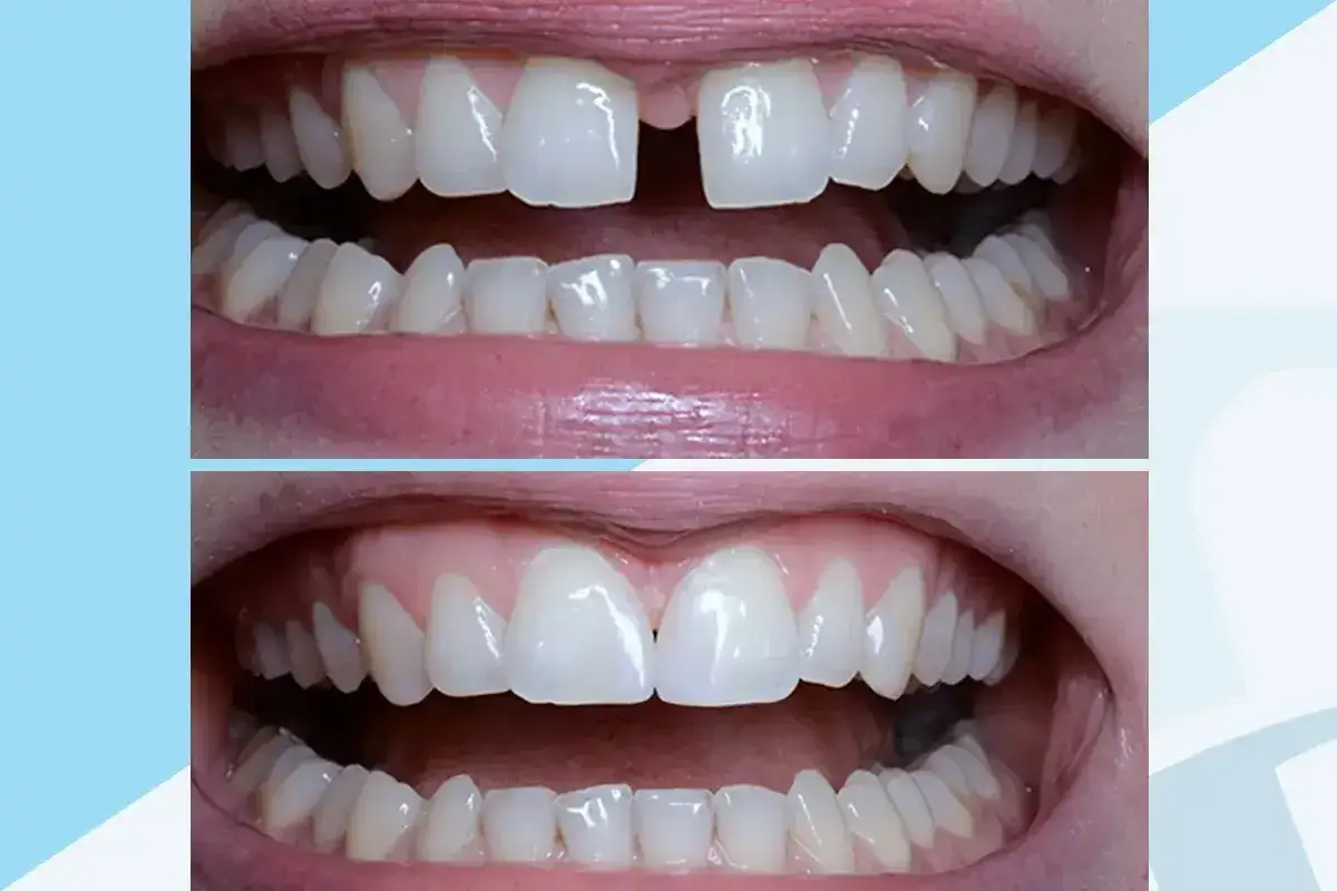 Przed i po: diastema zlikwidowana dzięki aparatowi ortodontycznemu. Uśmiech stał się pełniejszy i bardziej harmonijny.
