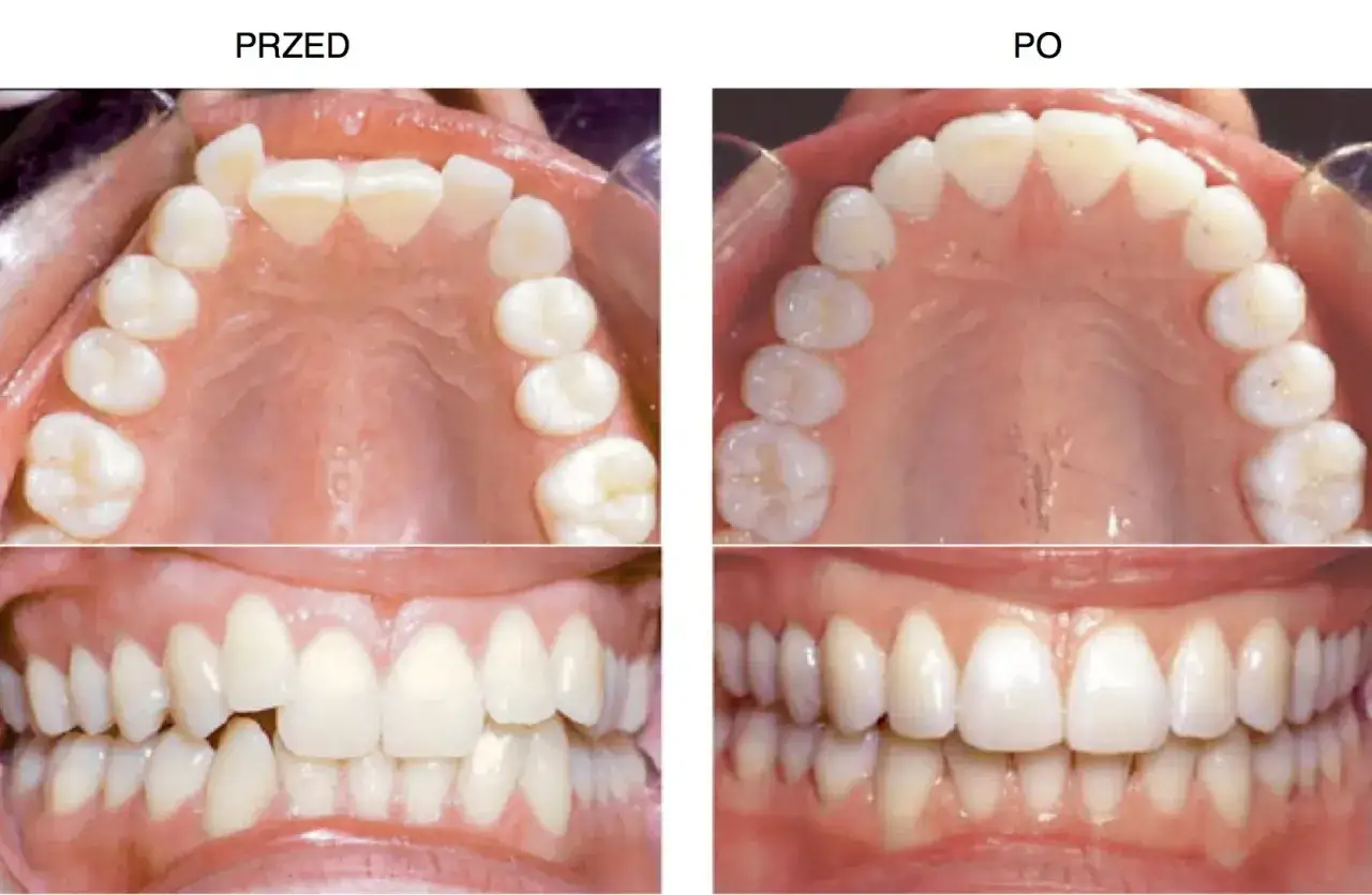 Przed i po leczeniu aparatem Invisalign. Widoczne znaczące poprawy w ustawieniu zębów, co pokazuje spektakularne efekty.