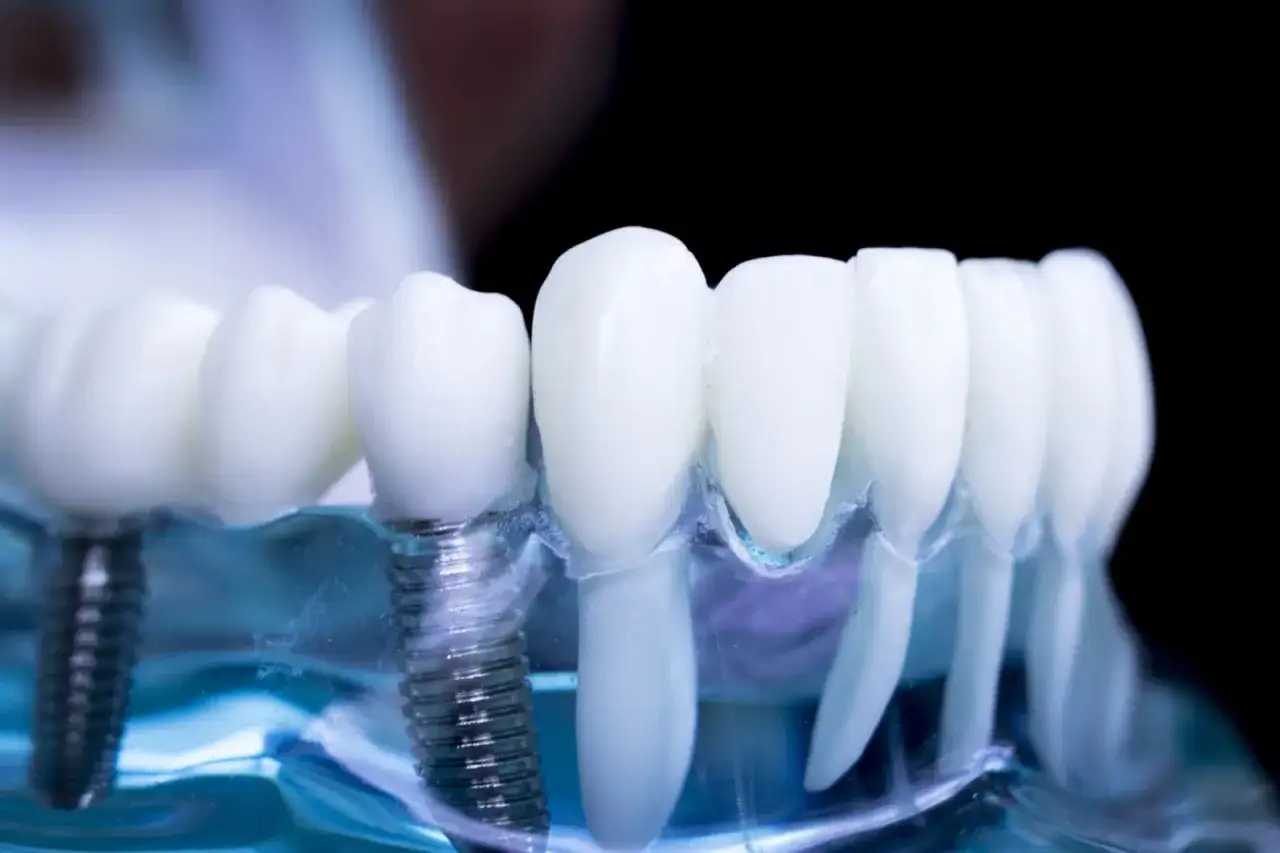 Model szczęki z implantami zębowymi i elementami przypominającymi aparat ortodontyczny.
