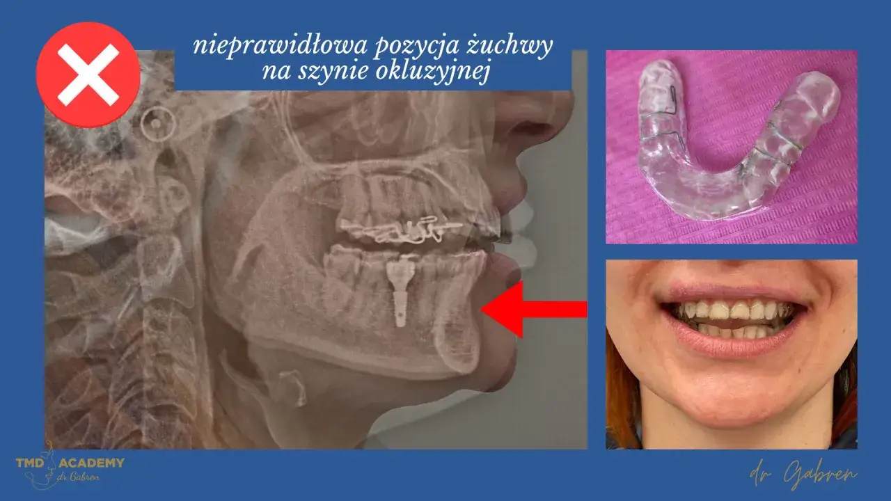 Rentgen żuchwy z nieprawidłową pozycją na szynie zgryzowej. Widoczna szyna i uśmiech pacjenta.