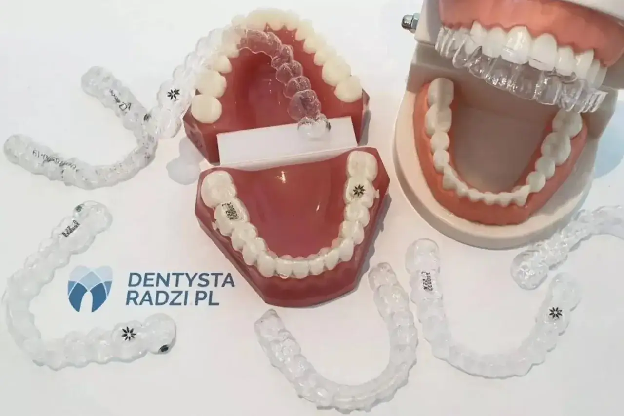 Model szczęki z nakładkami ortodontycznymi, pokazującymi efekt leczenia. Widoczne są przezroczyste alignery, które korygują zęby po leczeniu ortodontycznym.