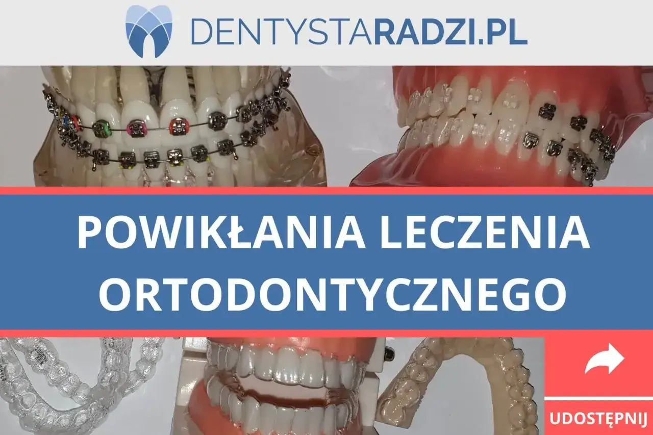 Modele szczęk z aparatami ortodontycznymi i nakładkami. Temat: powikłania leczenia ortodontycznego, w tym ból zębów po zdjęciu aparatu.
