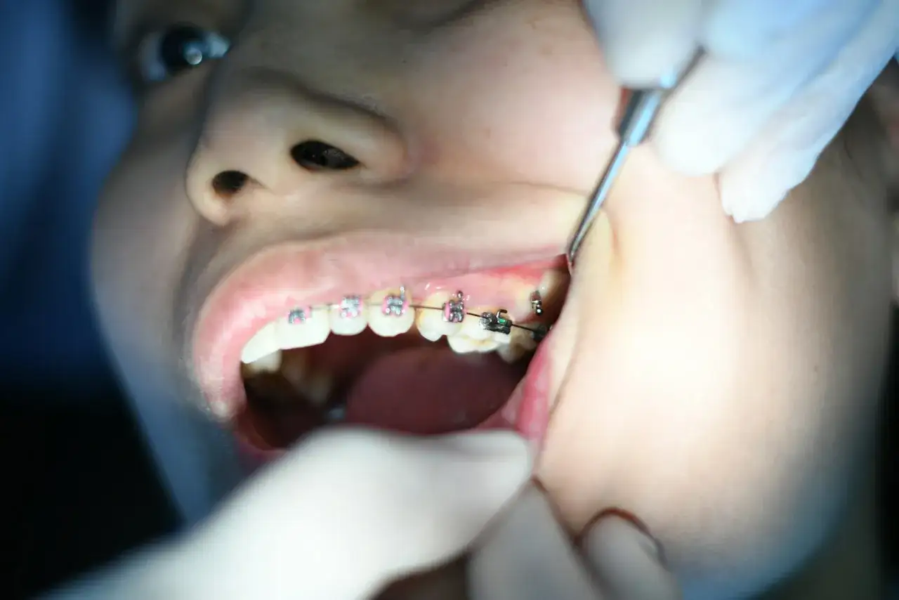 Uśmiech z różowymi i czarnymi elementami tradycyjnego aparatu ortodontycznego. Dentysta sprawdza zęby.