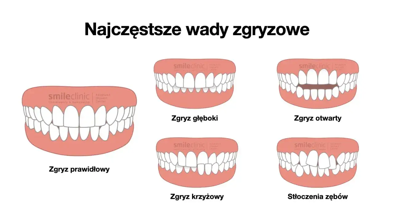 Ilustracja pokazuje różne wady zgryzu, w tym zgryz otwarty, gdzie zęby nie stykają się prawidłowo.