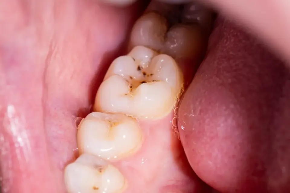 Chora ósemka - objawy próchnicy i kiedy do dentysty